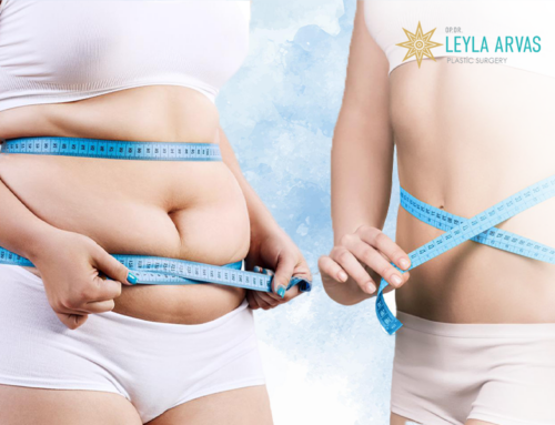 What is the Maximum Fat Removal with Liposuction?